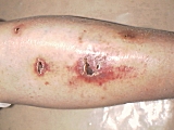 Lesión de piel